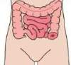 Colostomie