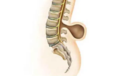 Meningocele